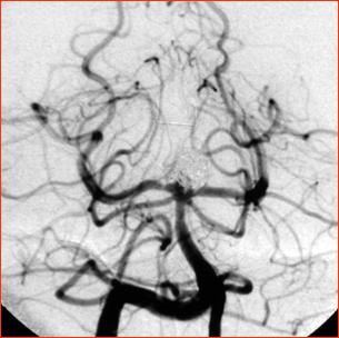 Ангиограмма основной артерии после операции с эмболизированной микроспиралями аневризмой