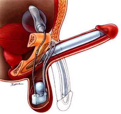 Механизм действия двухцилиндрового протеза полового члена