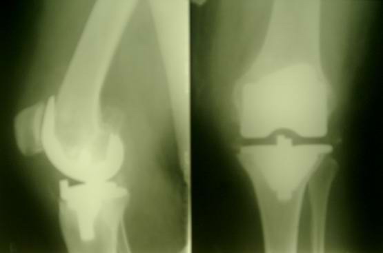 Эндопротезирование коленного сустава вид после операции