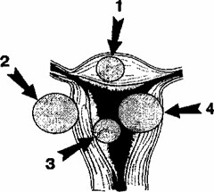 МИОМА МАТКИ - расположение узлов миомы по отношению к мышечному слою матки
