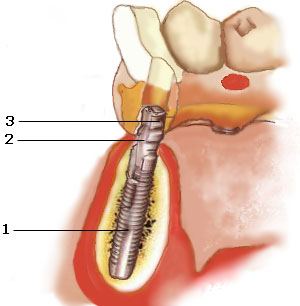 Имплантация ЗУБОВ - зубные ИМПЛАНТАНТЫ