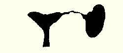 Правая труба отсутствует, левая непроходима - сактосальпинкс (маточная труба в виде "мешка")