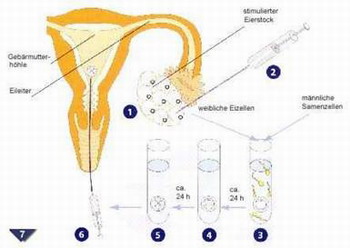 Лечение бесплодия в Германии - IVF (внутрицитоплазменная инъекция сперматозоида в пробирке)