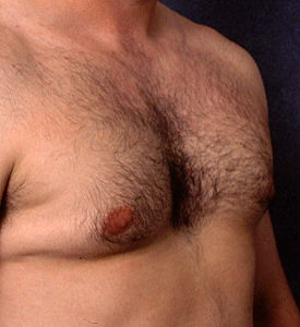 Пластика грудных мышц - до операции