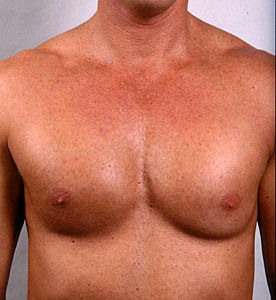 Пластика грудных мышц - после операции