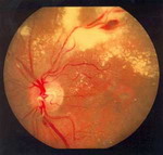ДИАБЕТ - Препролиферативная диабетическая ретинопатия. Отложения твердого и мягкого экссудата, геморрагии по ходу верхневисочного сосудистого пучка, неравномерное расширение вен.