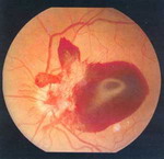 Неоваскуляризация диска зрительного нерва с преретинальными кровоизлияниями в центральной зоне глазного дна.
