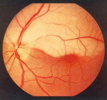 Окклюзия верхневисочной ветви центральной артерии сетчатки недельной давности. Ишемический отек сетчатки в верхней половине глазного дна.