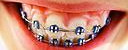 Ортодонтия – это раздел стоматологии, занимающийся исправлением и предупреждением нарушения положения зубов и аномалий прикуса.