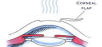 За последние 12 лет во всем мире проведено около 10 миллионов операций коррекции зрения с помощью эксимерного лазера.